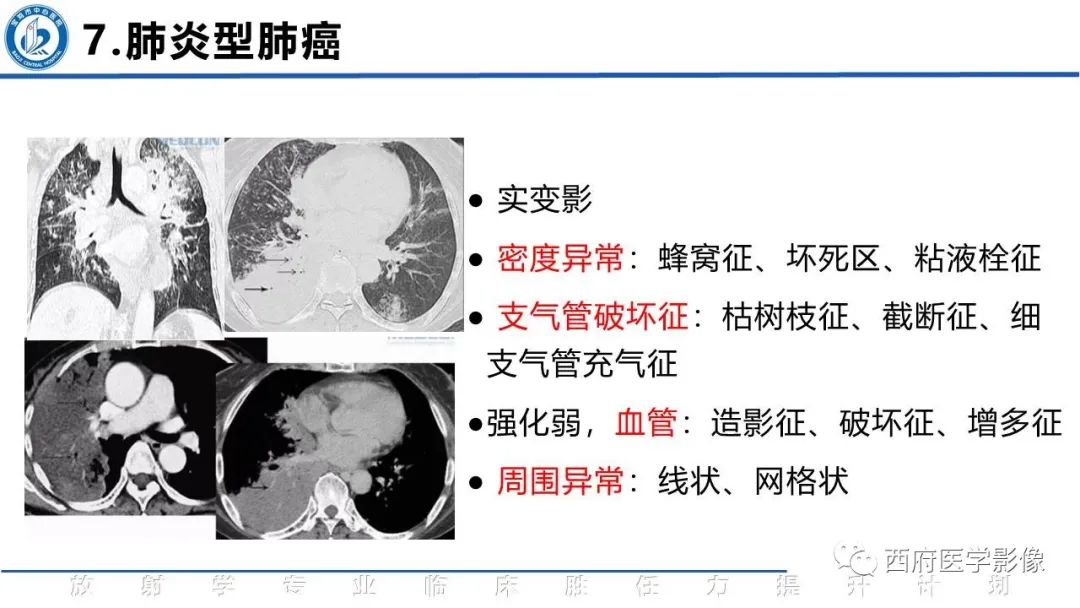 影像PPT - 【PPT】机化性肺炎影像学表现-40