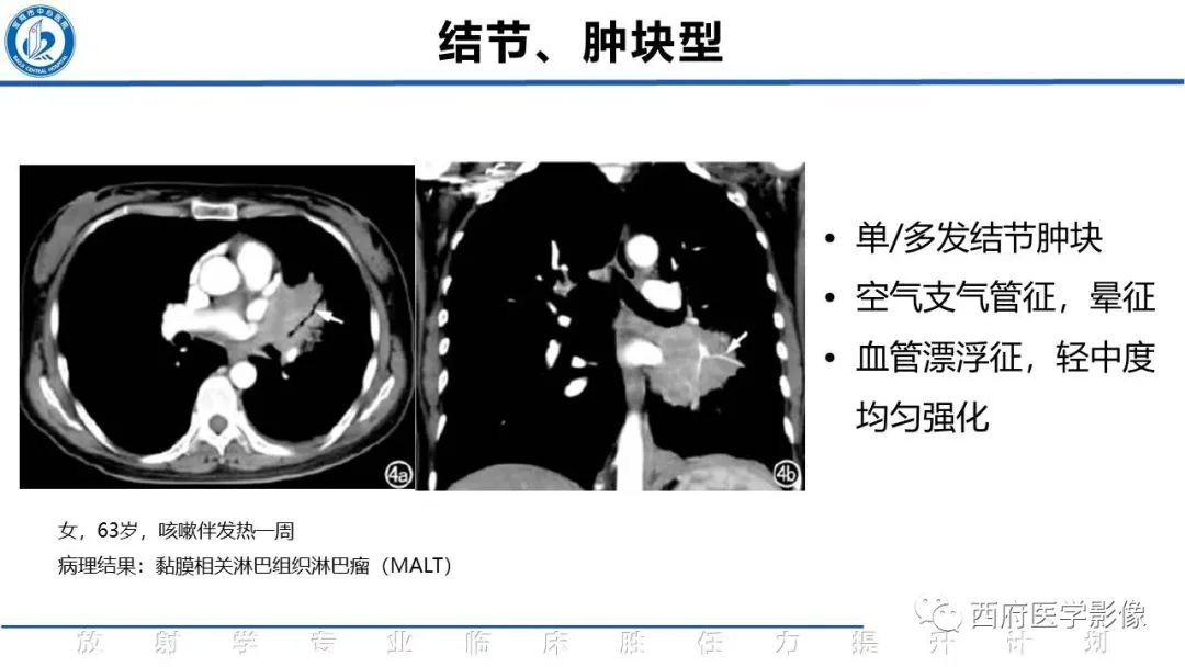 影像PPT - 【PPT】机化性肺炎影像学表现-42