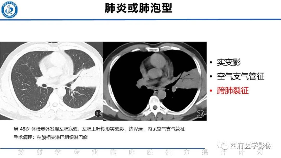 影像PPT - 【PPT】机化性肺炎影像学表现-43
