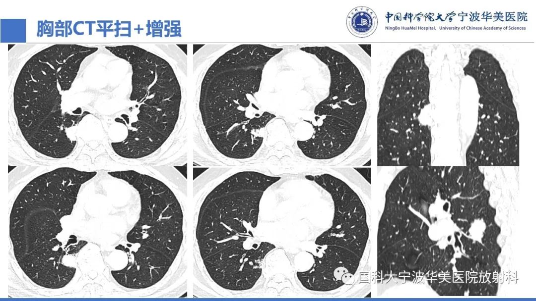 影像PPT - 【PPT】肺粘液腺癌-6