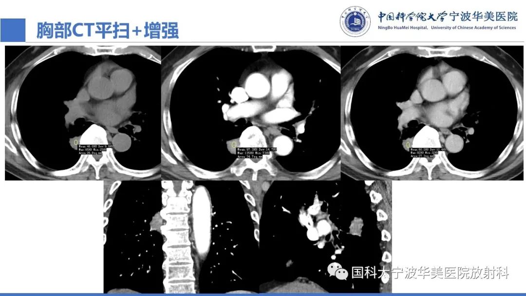 影像PPT - 【PPT】肺粘液腺癌-7
