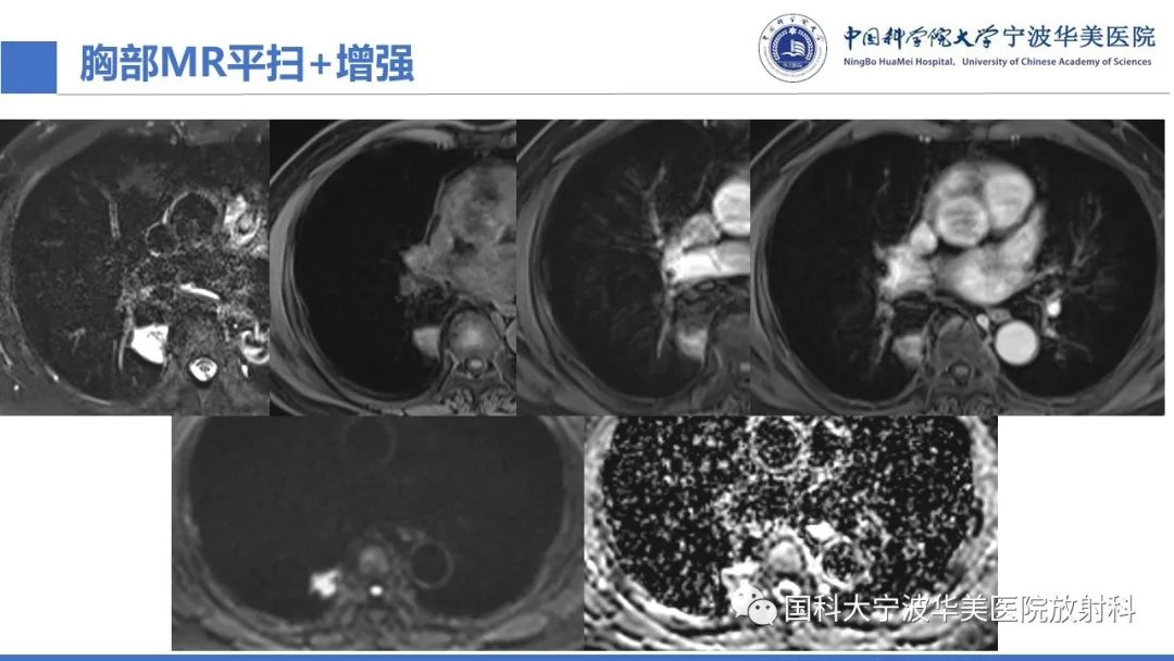 影像PPT - 【PPT】肺粘液腺癌-8