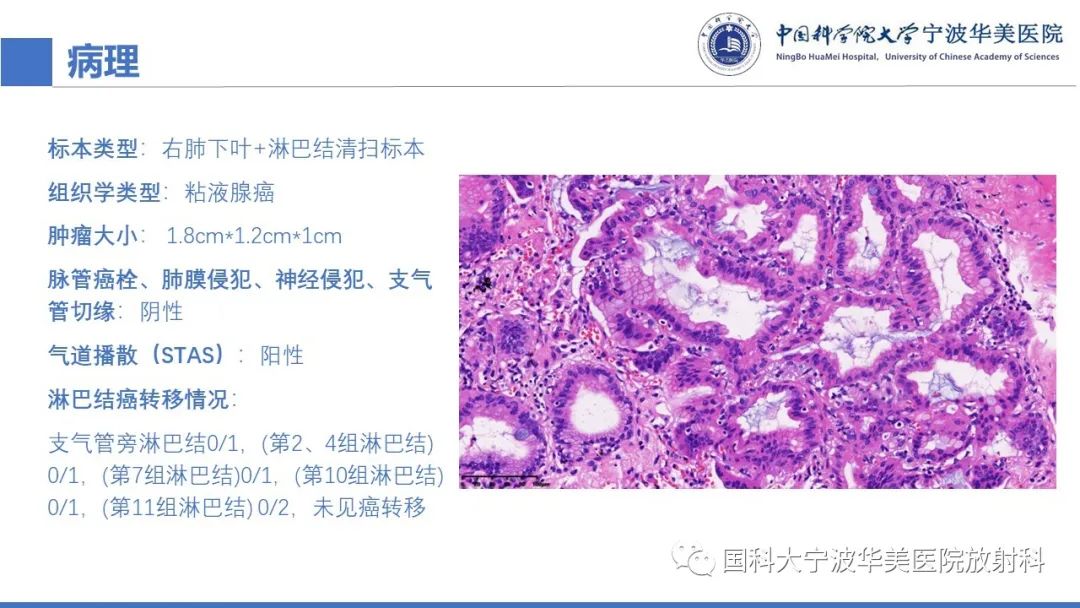 影像PPT - 【PPT】肺粘液腺癌-14