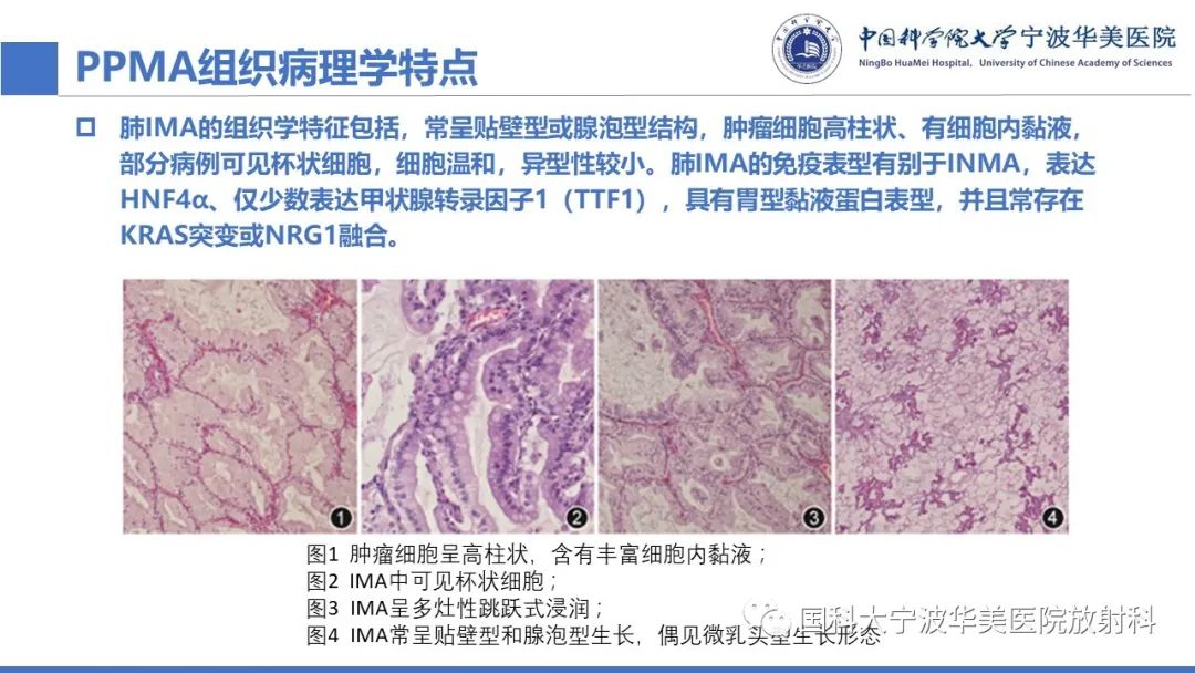 影像PPT - 【PPT】肺粘液腺癌-18