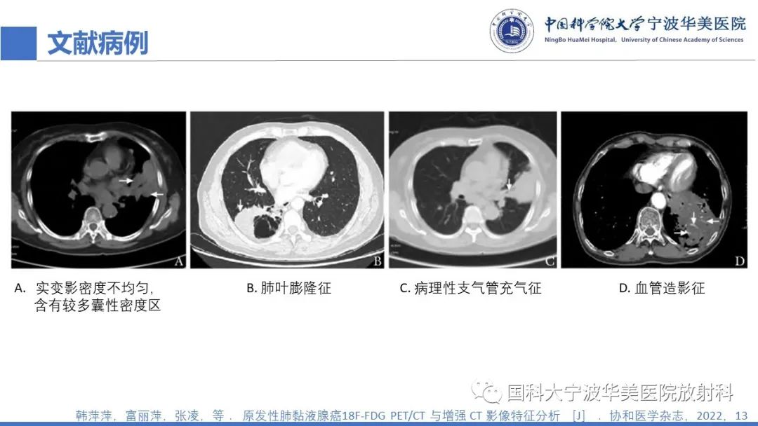影像PPT - 【PPT】肺粘液腺癌-21