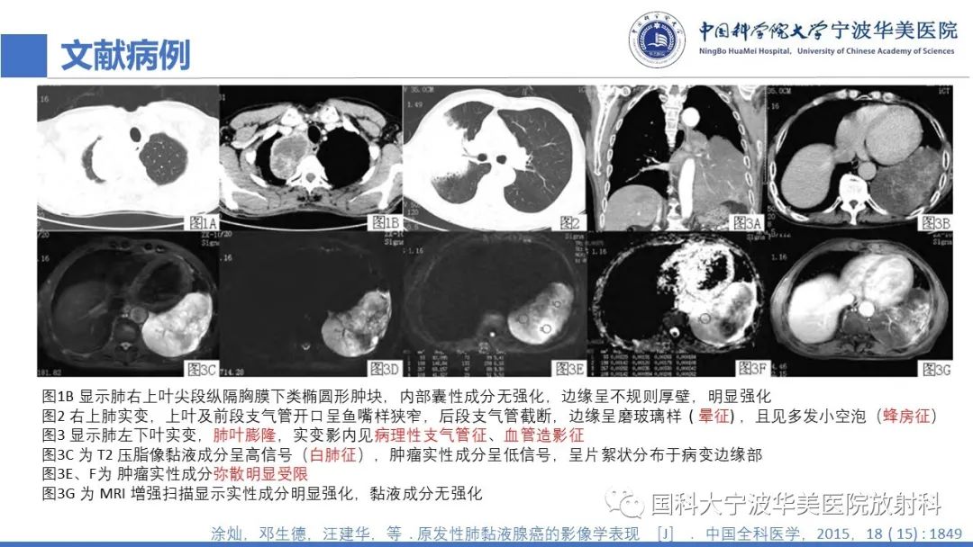影像PPT - 【PPT】肺粘液腺癌-22