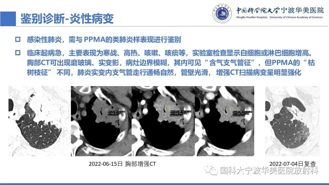 影像PPT - 【PPT】肺粘液腺癌-23