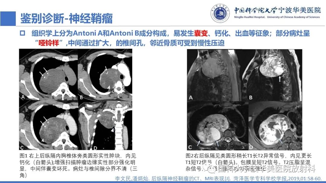 影像PPT - 【PPT】肺粘液腺癌-24