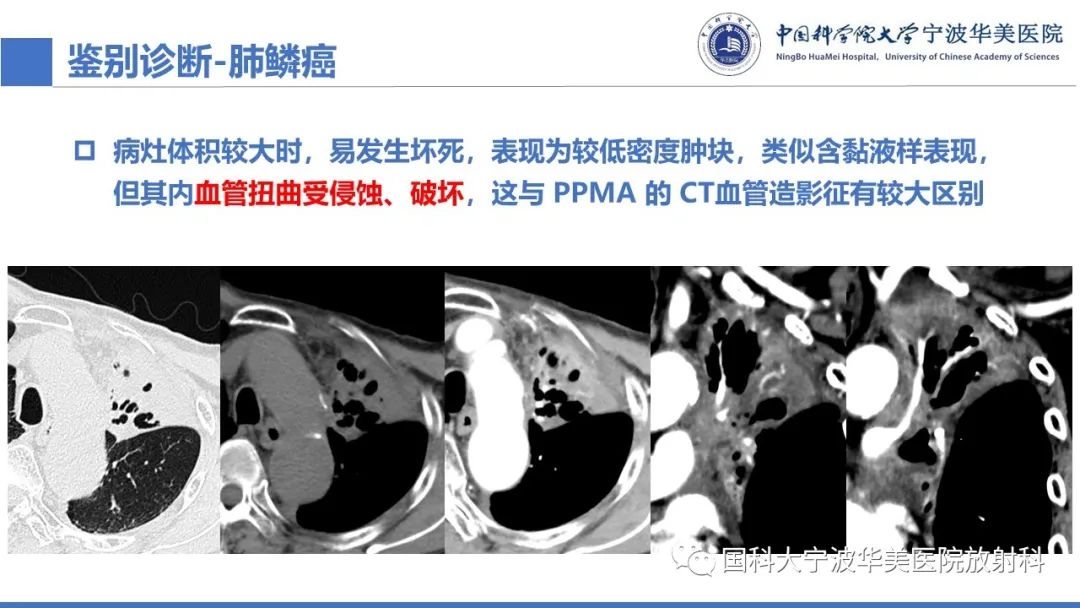 影像PPT - 【PPT】肺粘液腺癌-25