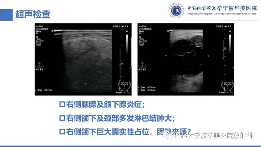 影像PPT - 【PPT】腮腺腺淋巴瘤-3