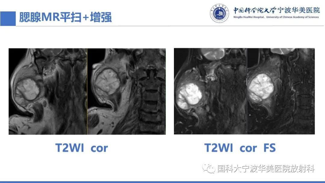 影像PPT - 【PPT】腮腺腺淋巴瘤-5