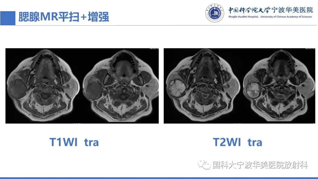 影像PPT - 【PPT】腮腺腺淋巴瘤-4