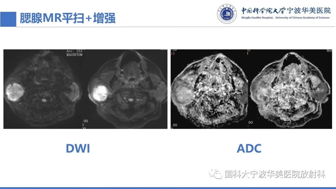 影像PPT - 【PPT】腮腺腺淋巴瘤-6
