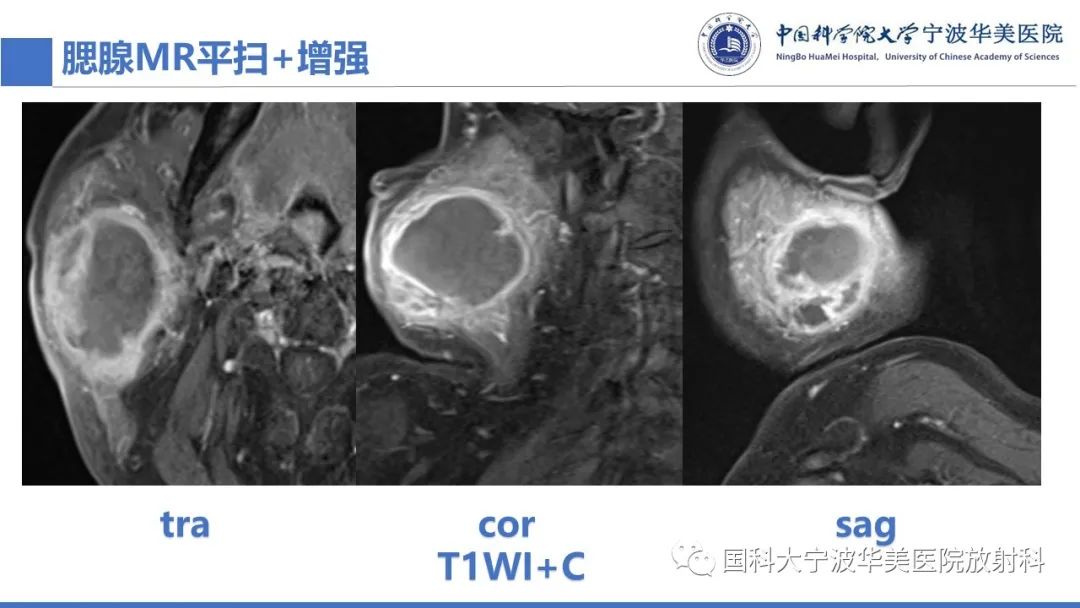 影像PPT - 【PPT】腮腺腺淋巴瘤-7