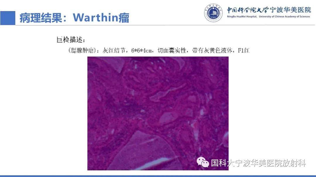 影像PPT - 【PPT】腮腺腺淋巴瘤-16