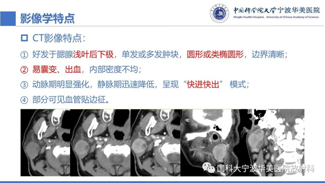 影像PPT - 【PPT】腮腺腺淋巴瘤-20