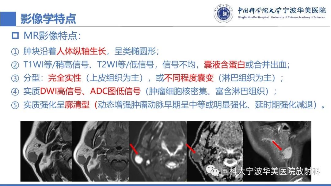 影像PPT - 【PPT】腮腺腺淋巴瘤-21