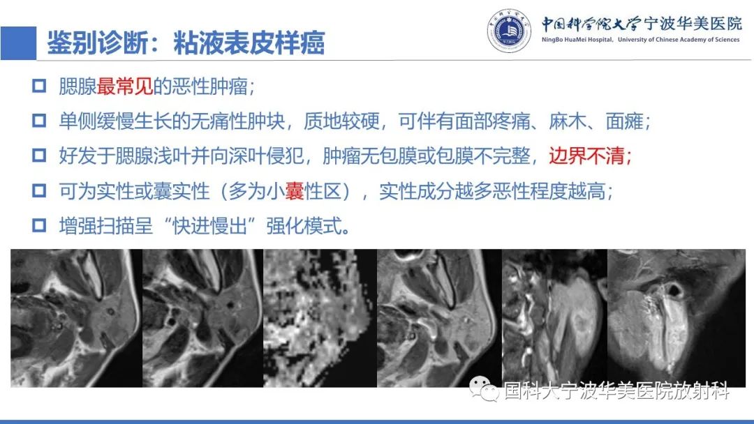 影像PPT - 【PPT】腮腺腺淋巴瘤-23