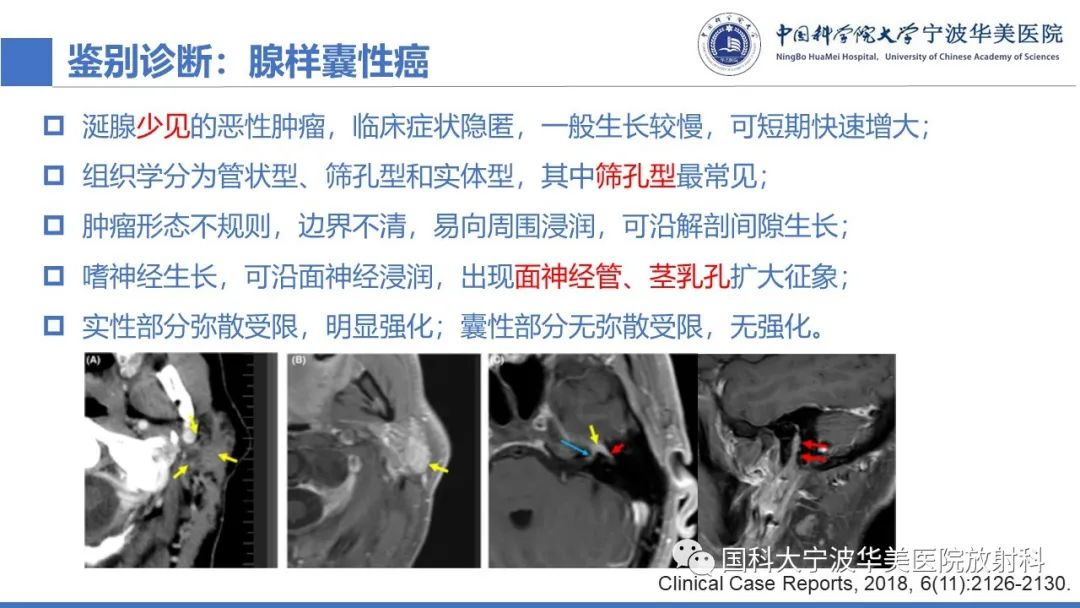 影像PPT - 【PPT】腮腺腺淋巴瘤-24