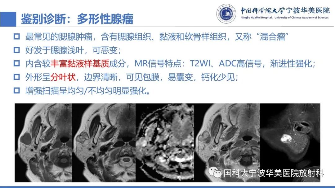 影像PPT - 【PPT】腮腺腺淋巴瘤-25