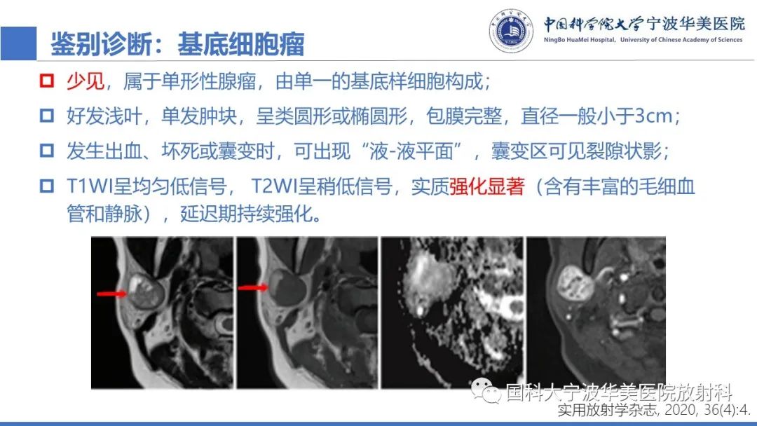影像PPT - 【PPT】腮腺腺淋巴瘤-26