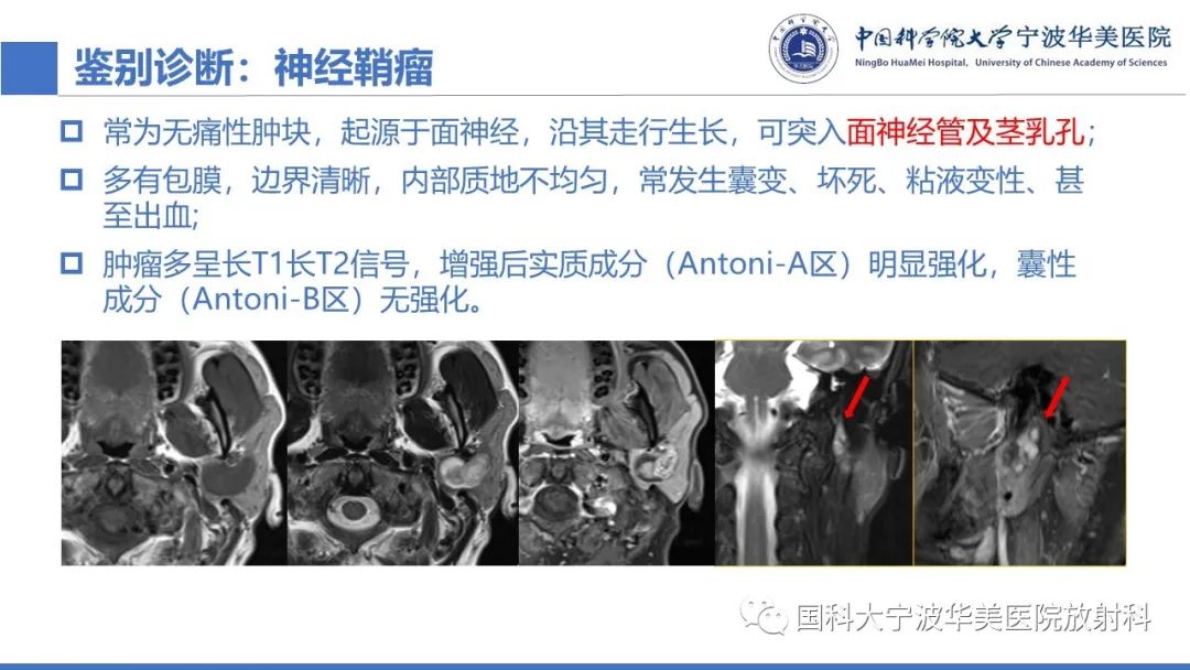 影像PPT - 【PPT】腮腺腺淋巴瘤-27