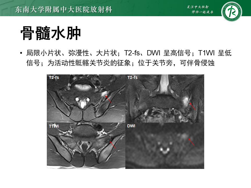 影像PPT - 【PPT】强直性脊柱炎-15 影像PPT - 【PPT】强直性脊柱炎-15