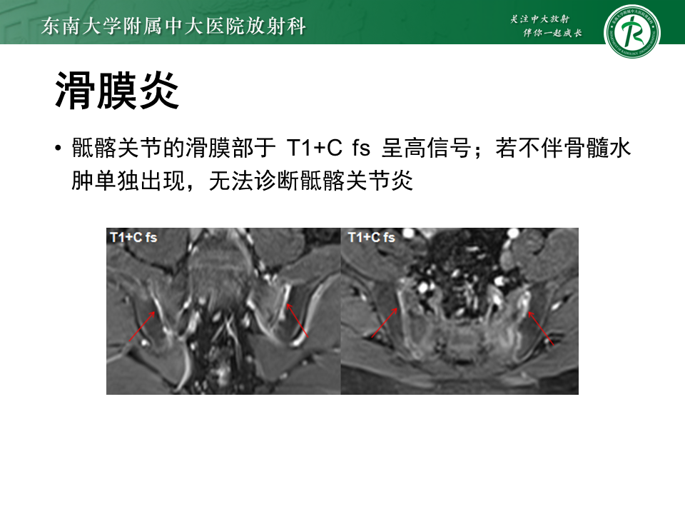 影像PPT - 【PPT】强直性脊柱炎-16 影像PPT - 【PPT】强直性脊柱炎-16