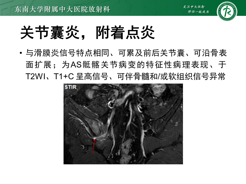 影像PPT - 【PPT】强直性脊柱炎-17 影像PPT - 【PPT】强直性脊柱炎-17