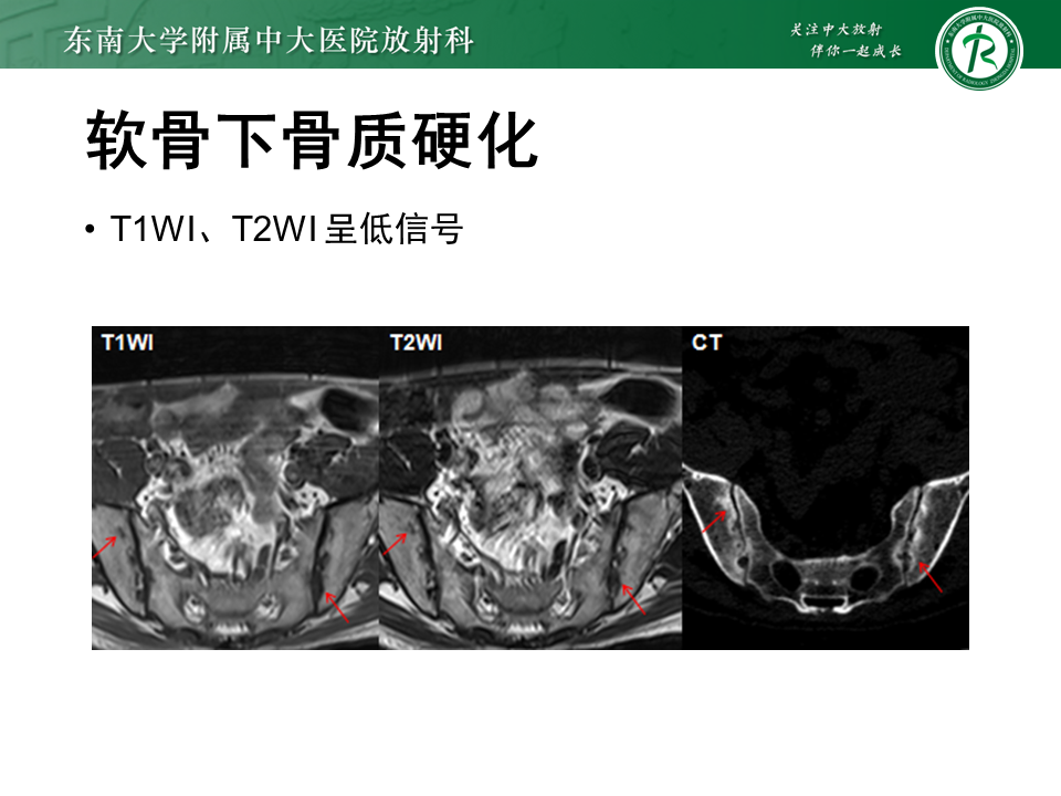 影像PPT - 【PPT】强直性脊柱炎-19 影像PPT - 【PPT】强直性脊柱炎-19