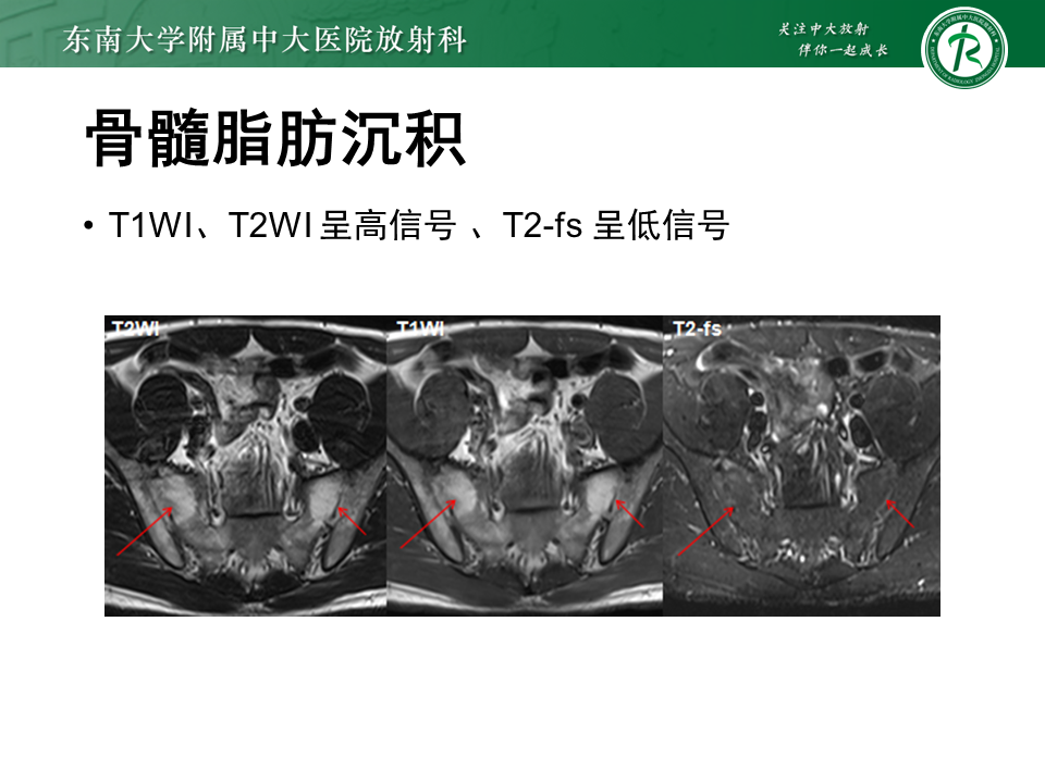 影像PPT - 【PPT】强直性脊柱炎-20 影像PPT - 【PPT】强直性脊柱炎-20