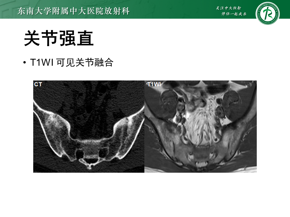 影像PPT - 【PPT】强直性脊柱炎-21 影像PPT - 【PPT】强直性脊柱炎-21