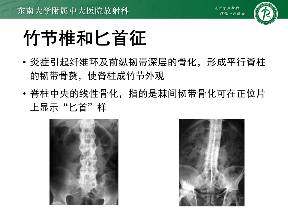 影像PPT - 【PPT】强直性脊柱炎-23 影像PPT - 【PPT】强直性脊柱炎-23