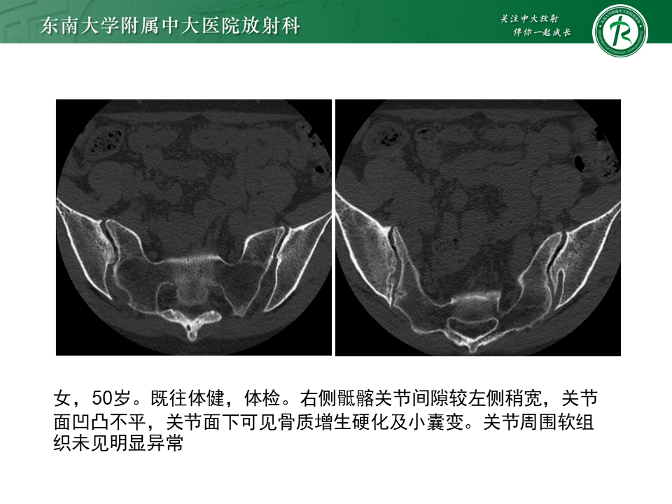 影像PPT - 【PPT】强直性脊柱炎-29 影像PPT - 【PPT】强直性脊柱炎-29