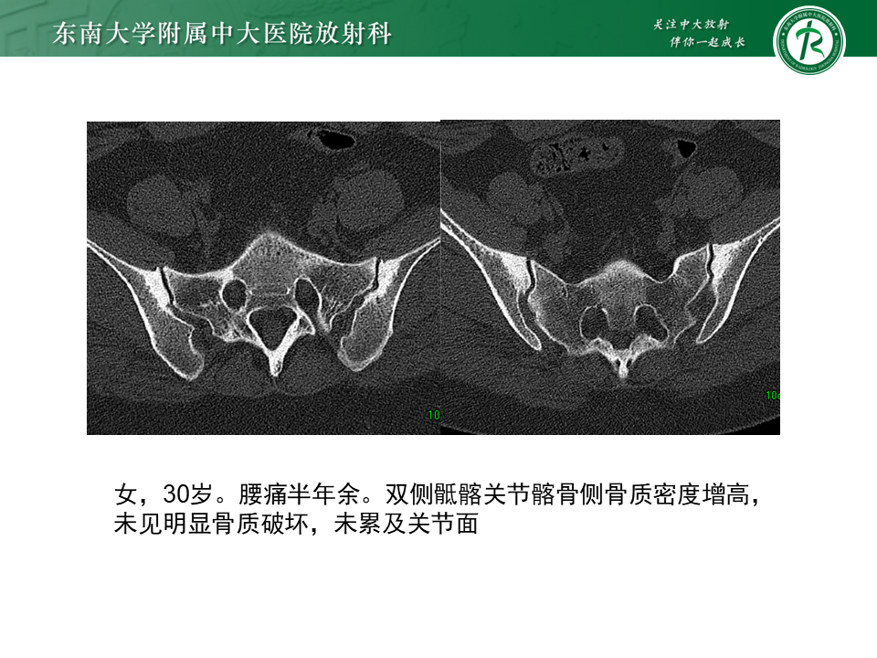 影像PPT - 【PPT】强直性脊柱炎-31 影像PPT - 【PPT】强直性脊柱炎-31