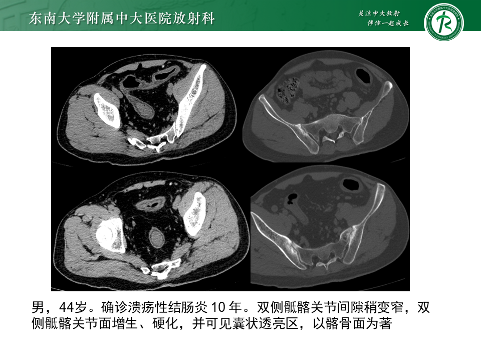 影像PPT - 【PPT】强直性脊柱炎-33 影像PPT - 【PPT】强直性脊柱炎-33