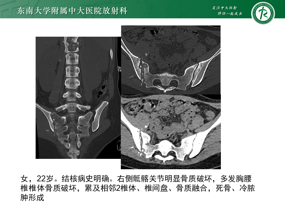 影像PPT - 【PPT】强直性脊柱炎-35 影像PPT - 【PPT】强直性脊柱炎-35