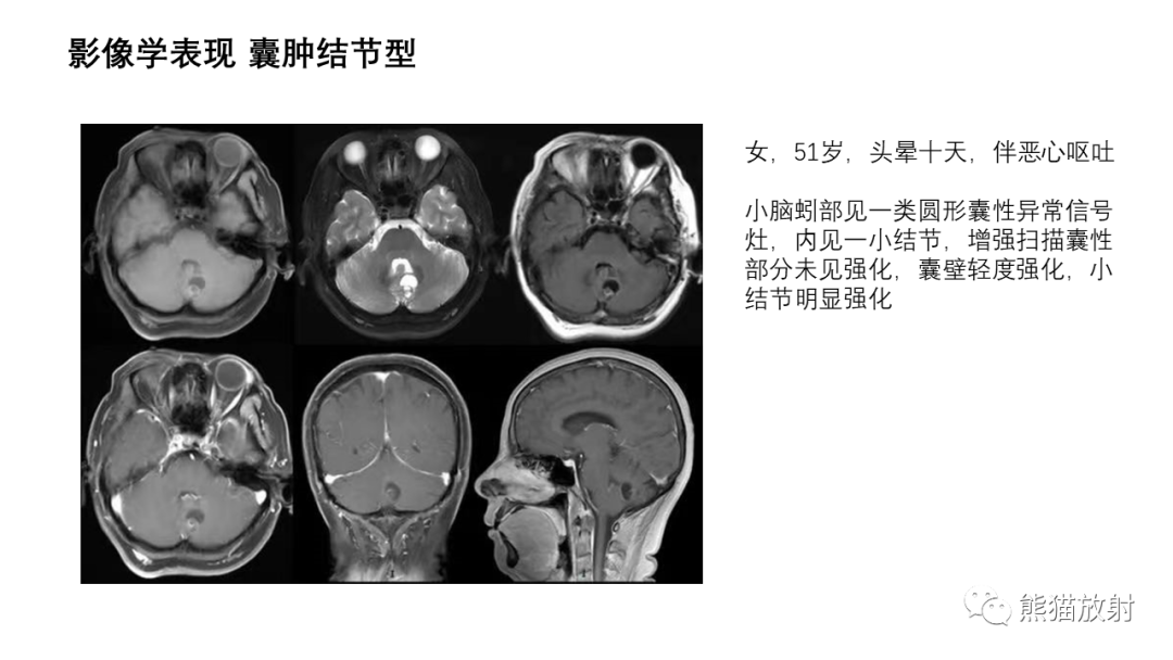 影像PPT - 【病例】小脑毛细胞星形细胞瘤 VS 血管母细胞瘤-20
