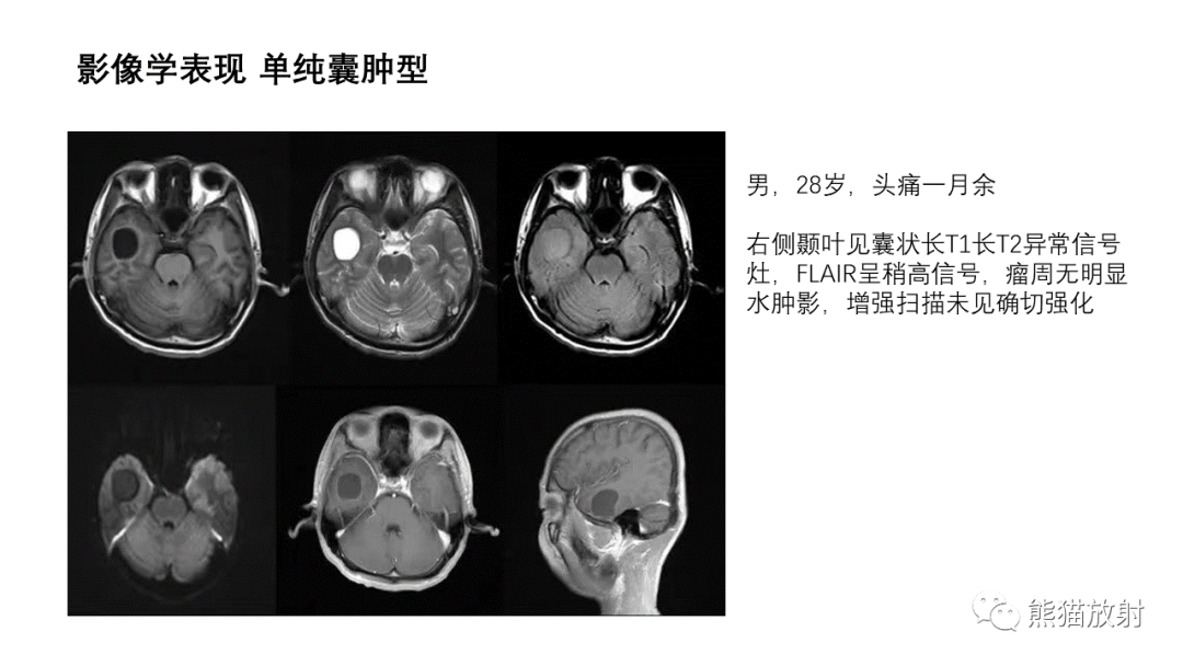 影像PPT - 【病例】小脑毛细胞星形细胞瘤 VS 血管母细胞瘤-19