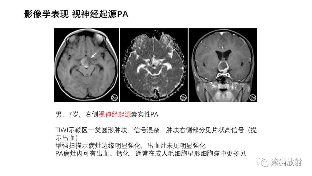 影像PPT - 【病例】小脑毛细胞星形细胞瘤 VS 血管母细胞瘤-21