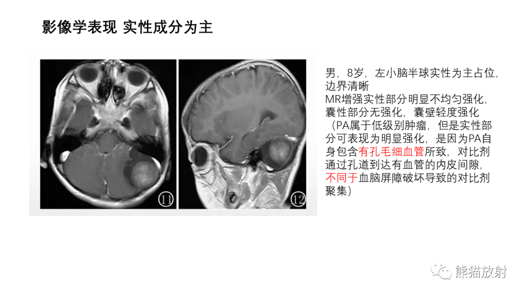 影像PPT - 【病例】小脑毛细胞星形细胞瘤 VS 血管母细胞瘤-23