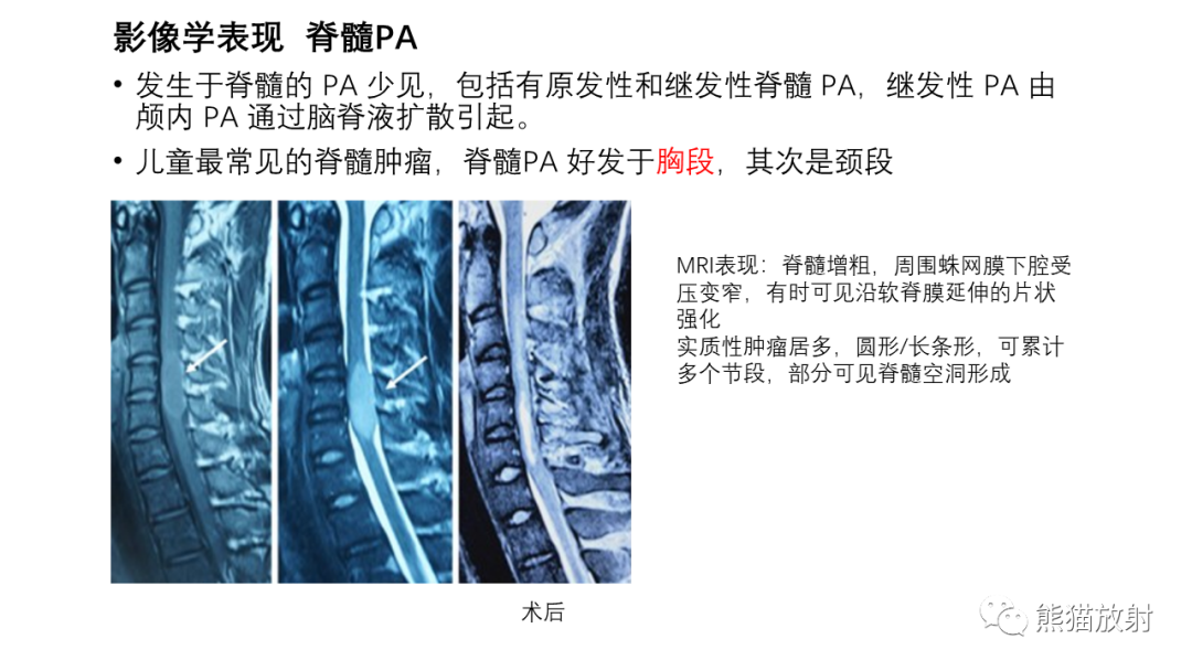 影像PPT - 【病例】小脑毛细胞星形细胞瘤 VS 血管母细胞瘤-24
