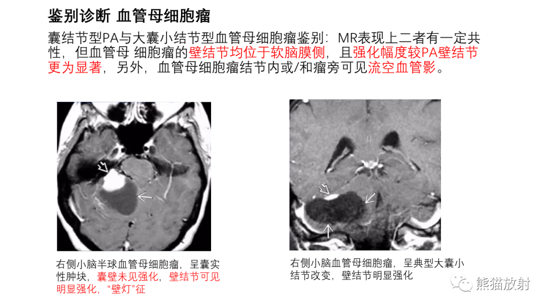 影像PPT - 【病例】小脑毛细胞星形细胞瘤 VS 血管母细胞瘤-27