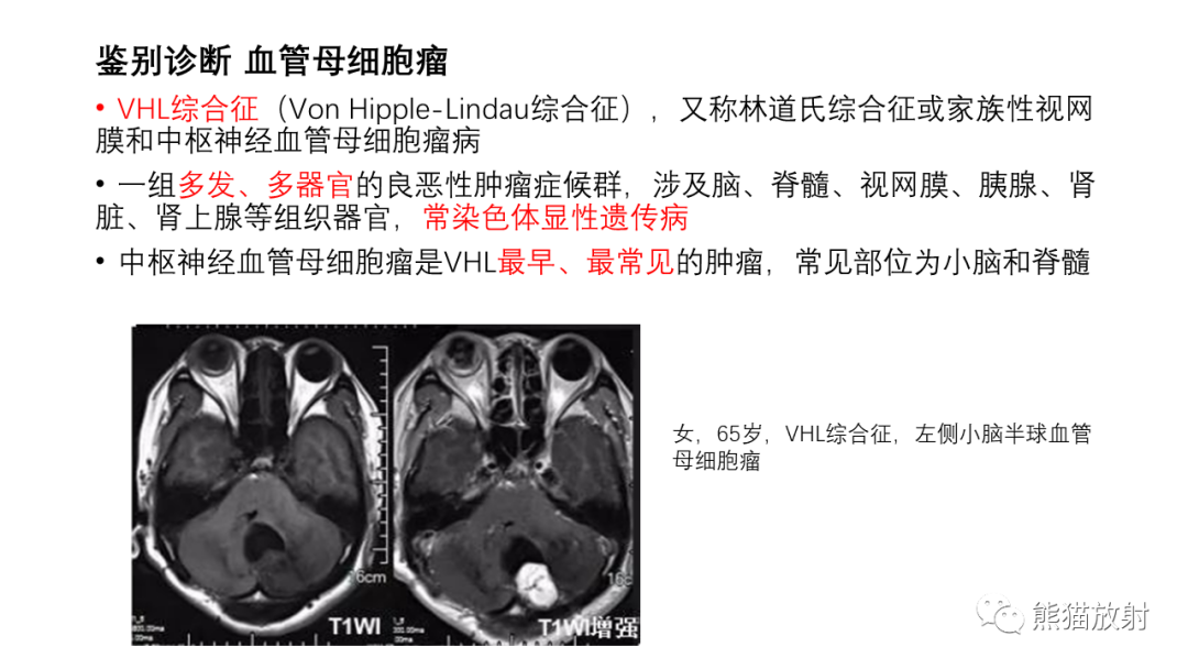 影像PPT - 【病例】小脑毛细胞星形细胞瘤 VS 血管母细胞瘤-28