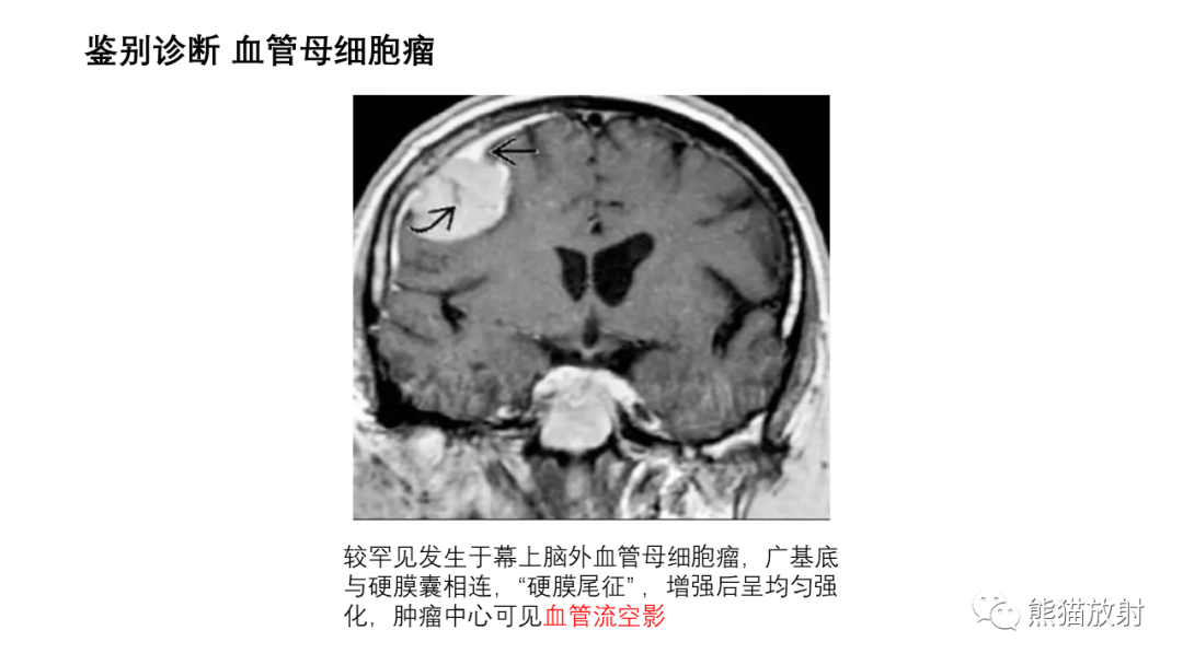 影像PPT - 【病例】小脑毛细胞星形细胞瘤 VS 血管母细胞瘤-29