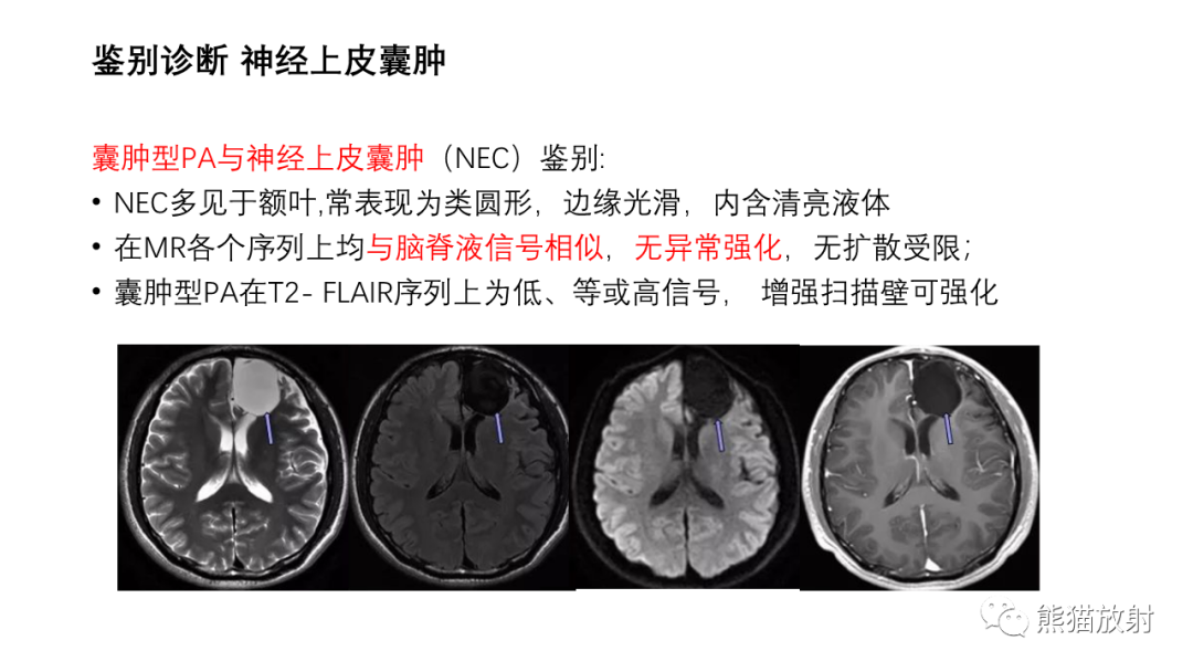 影像PPT - 【病例】小脑毛细胞星形细胞瘤 VS 血管母细胞瘤-30
