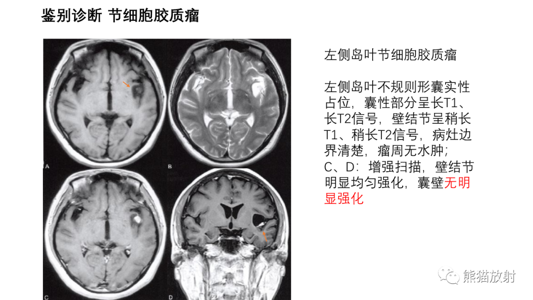 影像PPT - 【病例】小脑毛细胞星形细胞瘤 VS 血管母细胞瘤-32