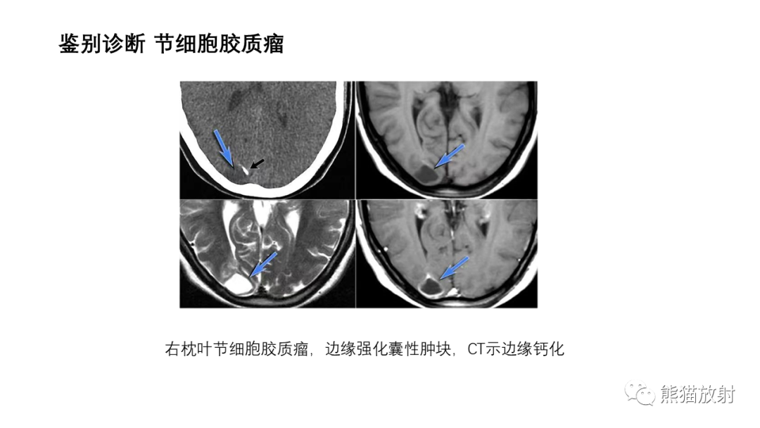 影像PPT - 【病例】小脑毛细胞星形细胞瘤 VS 血管母细胞瘤-33