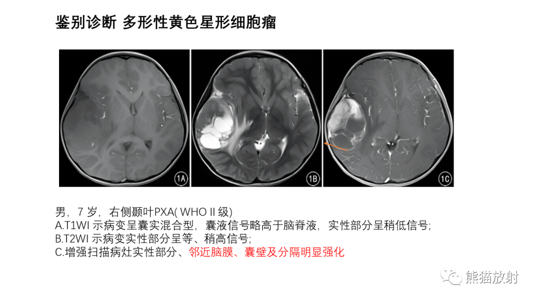 影像PPT - 【病例】小脑毛细胞星形细胞瘤 VS 血管母细胞瘤-35
