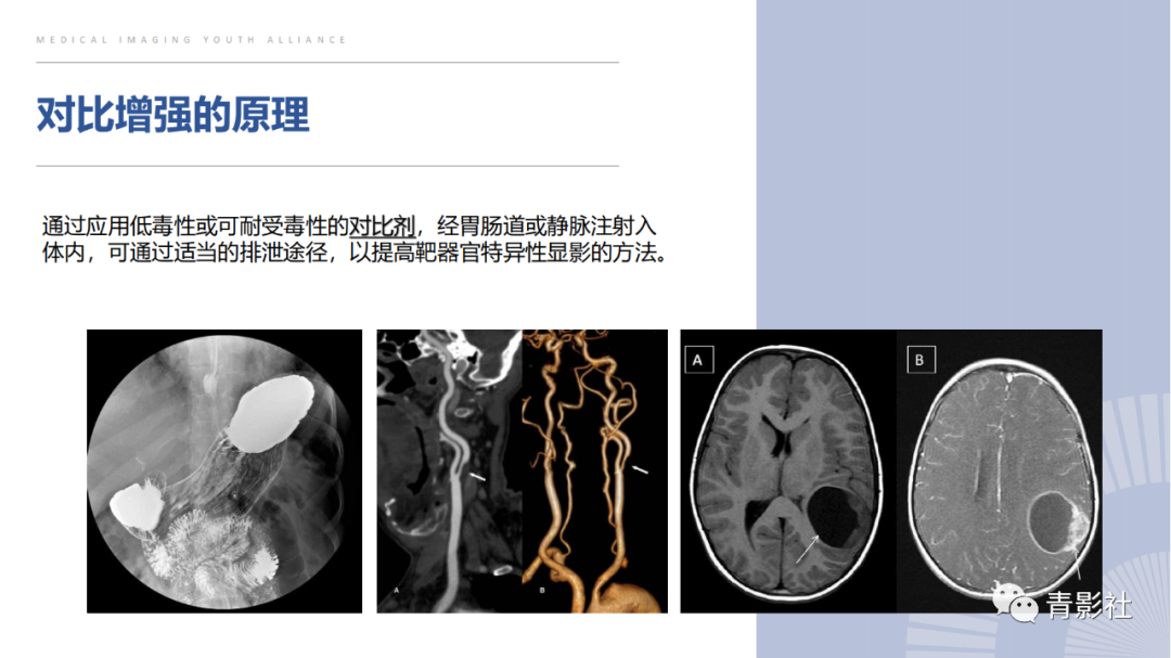 影像PPT - 【PPT】肝环形强化样病变MRI诊断思路-4
